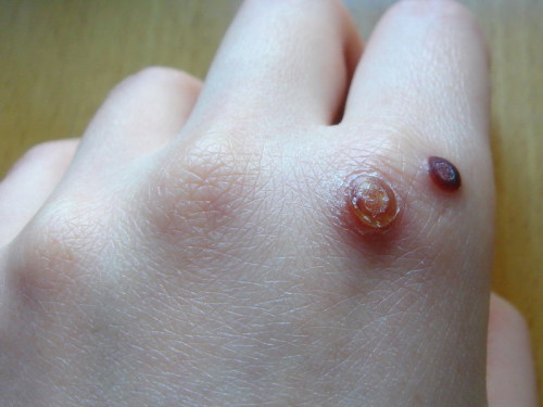 身上长的瘊子分公母吗,去除瘊子公母最佳方法