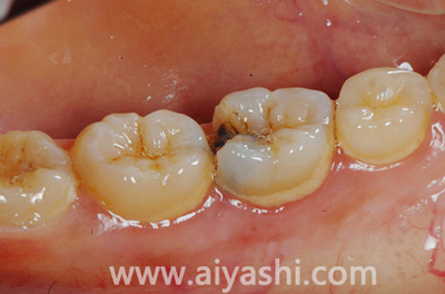 中年牙缝越来越大是什么原因,门牙缝越来越大是什么导致的