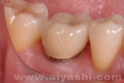 中年牙缝越来越大是什么原因,门牙缝越来越大是什么导致的