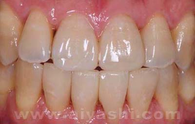 中年牙缝越来越大是什么原因,门牙缝越来越大是什么导致的