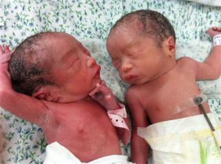 唐氏儿在医院怎么照顾,家有唐氏儿怎么办