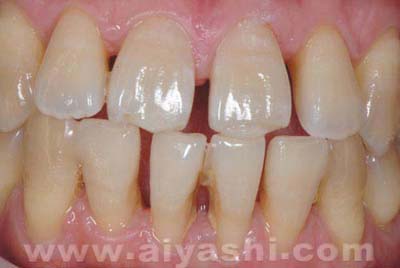 中年牙缝越来越大是什么原因,门牙缝越来越大是什么导致的