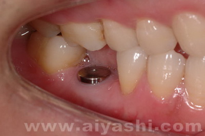 中年牙缝越来越大是什么原因,门牙缝越来越大是什么导致的