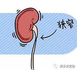 肾积水——尿都堵了，肾怎么能好