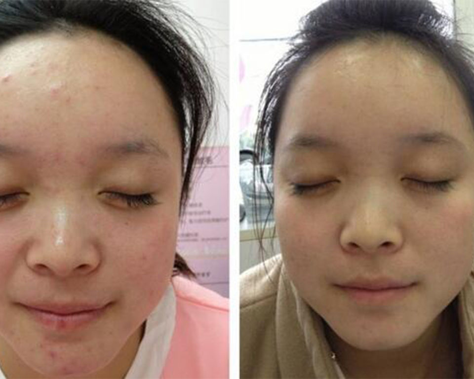 男孩额头长痘是什么原因,眉毛和额头长痘怎么回事