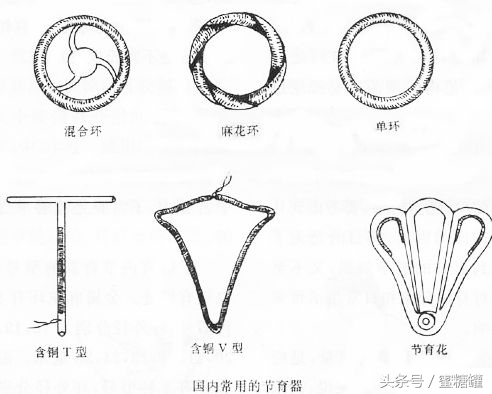 上环避孕会宫外孕吗,上环会生宫颈囊肿和子宫肌瘤吗