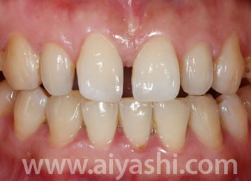 中年牙缝越来越大是什么原因,门牙缝越来越大是什么导致的