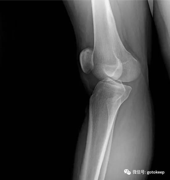 膝盖超伸腿粗矫正方法,膝超伸大腿粗怎么改善