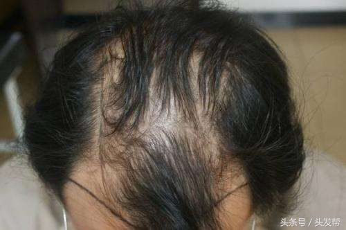 脱发到底都是什么原因，都有哪些原因？你又中招了吗？