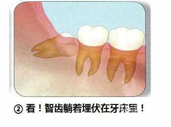 智齿横着长没露出来,智齿牙横着长怎么办