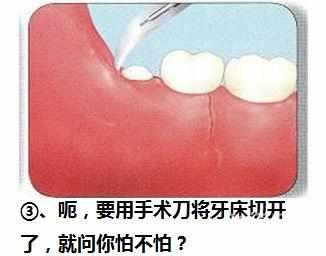 智齿横着长没露出来,智齿牙横着长怎么办