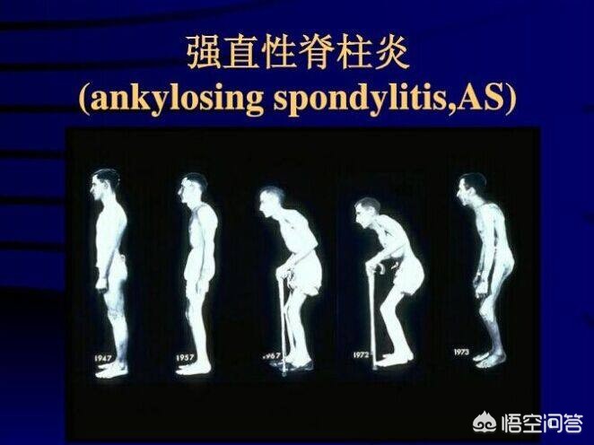 晨起时腰部酸痛是怎么回事,晨起腰骶骨疼起来就缓解咋回事