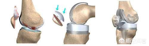 膝关节痛上下楼梯痛教你一招缓解,走平路时膝关节疼痛是什么原因