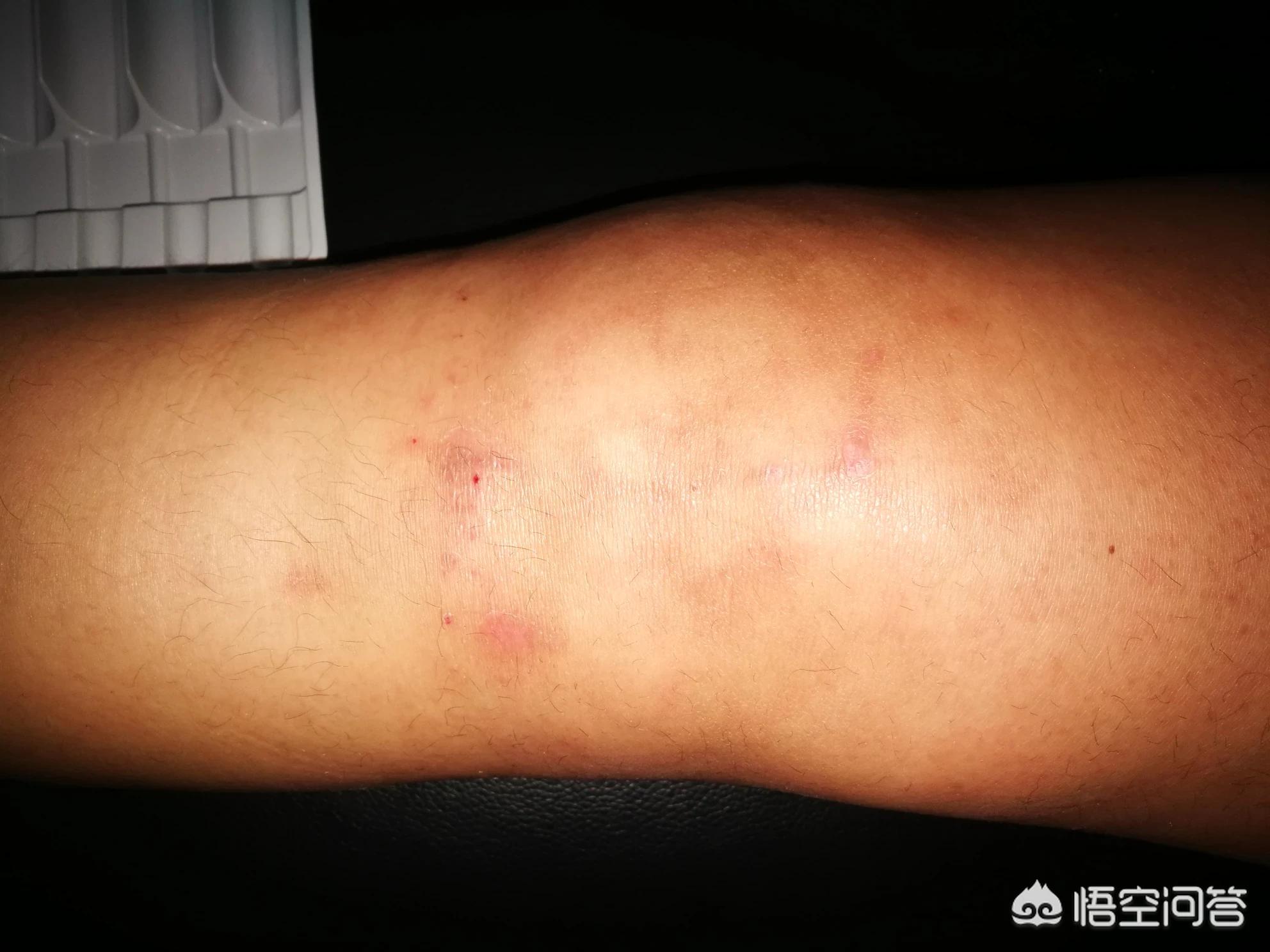 膝盖积水用烤灯能烤好吗？粗盐呢？医生：明确诊断针对治疗是关键