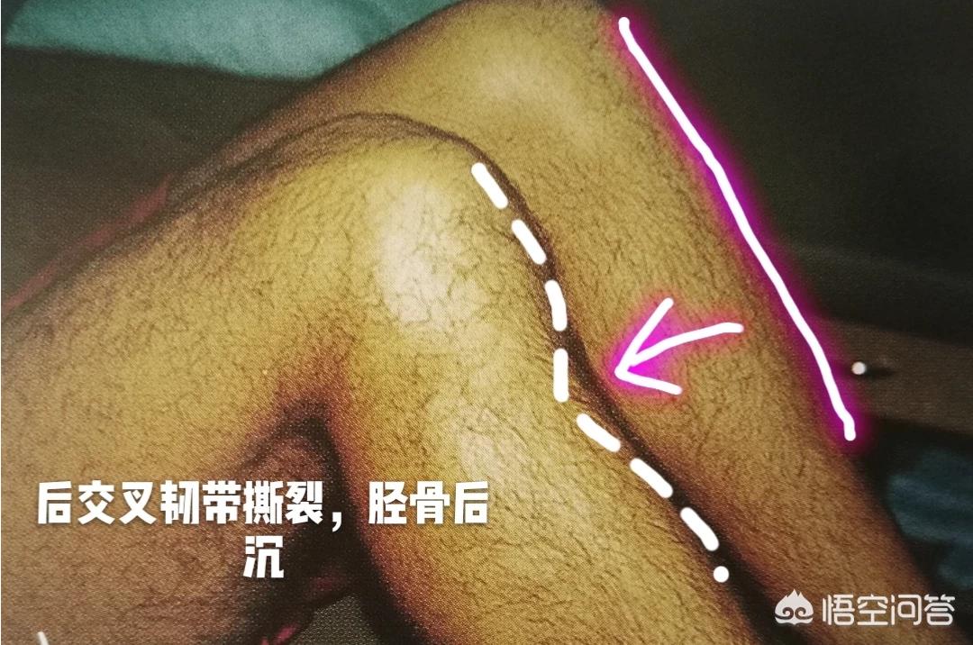 交叉韧带撕裂什么症状,交叉韧带撕裂怎么恢复正常