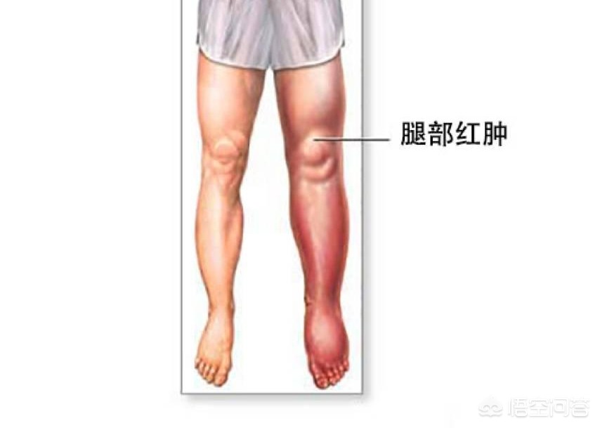 骨折手术后有点隐隐的疼正常吗,骨折手术后下肢血栓怎么办