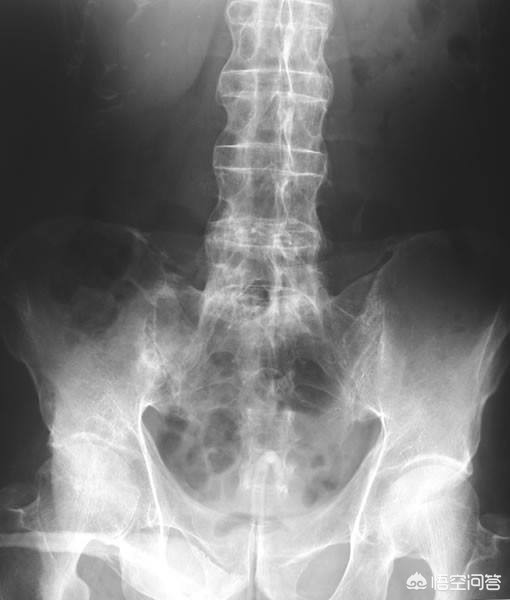 晨起时腰部酸痛是怎么回事,晨起腰骶骨疼起来就缓解咋回事