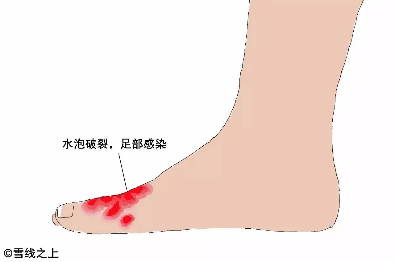 徒步走线时，如何防治水泡？