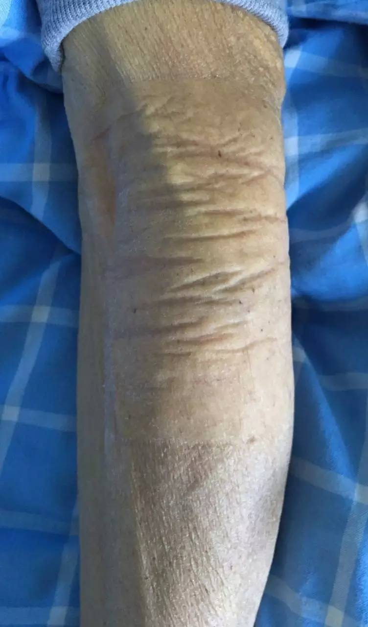 造影剂外渗如何处理,做cta时造影剂外渗怎么办