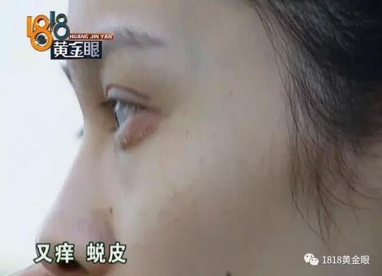 姑娘*款贷**八万在杭州整形没效果医院：术后她就喝酒化妆