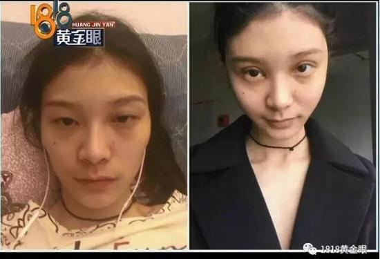 姑娘*款贷**八万在杭州整形没效果医院：术后她就喝酒化妆