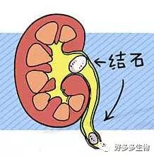 肾积水——尿都堵了，肾怎么能好