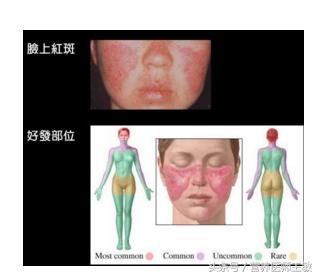 狼疮性肾炎生活及饮食宜忌,狼疮性肾炎患者日常生活关注事项