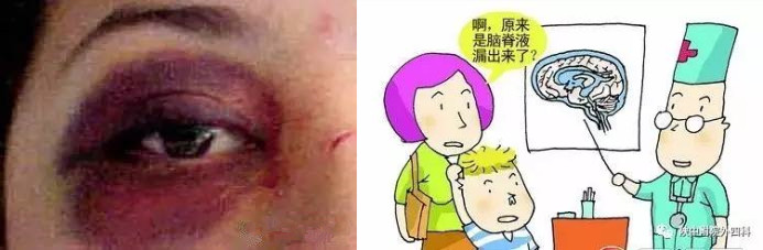 颅底骨折导致右耳出血,颅底骨折耳朵出血需要多久治愈