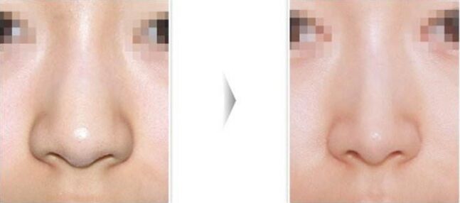 鼻翼缩小鼻子更大,让鼻翼缩小的方法