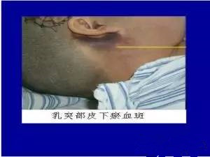 颅底骨折导致右耳出血,颅底骨折耳朵出血需要多久治愈