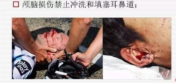 颅底骨折导致右耳出血,颅底骨折耳朵出血需要多久治愈