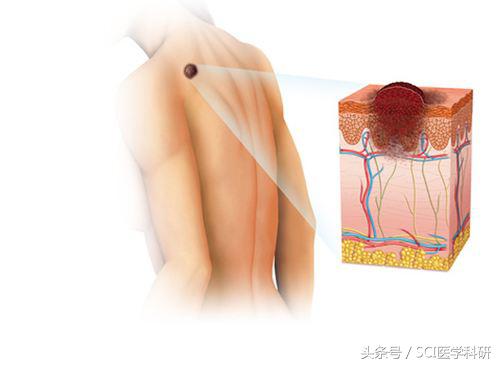 转移性恶性黑色素瘤有效治疗方法,黑色素瘤新型靶向疗法有望开发