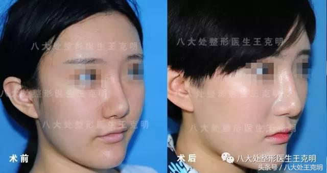 鼻整形后出现肿胀、假体外露歪斜、皮肤异样该怎么办？