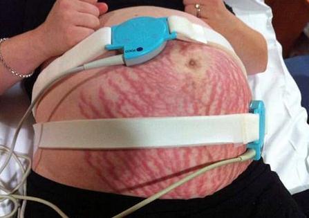 孕妇出现很多纹,孕妇肚子上长妊娠纹有拉扯感