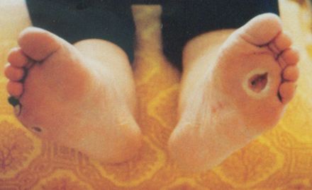 2型糖尿病皮肤病是什么样,2型糖尿病最常见的急性并发症是