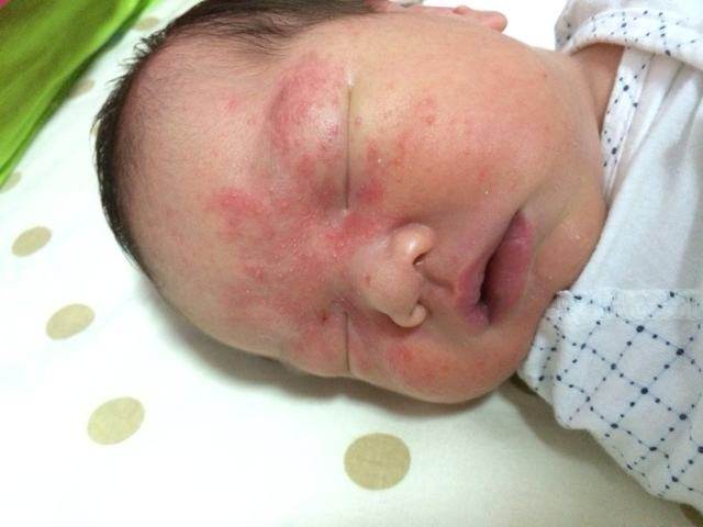 新生儿起红疹怎么回事,新生儿满月后满脸红疹
