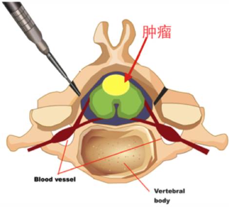 腰腿疼是椎管肿瘤吗,腰腿疼痛需要关注脊髓肿瘤吗