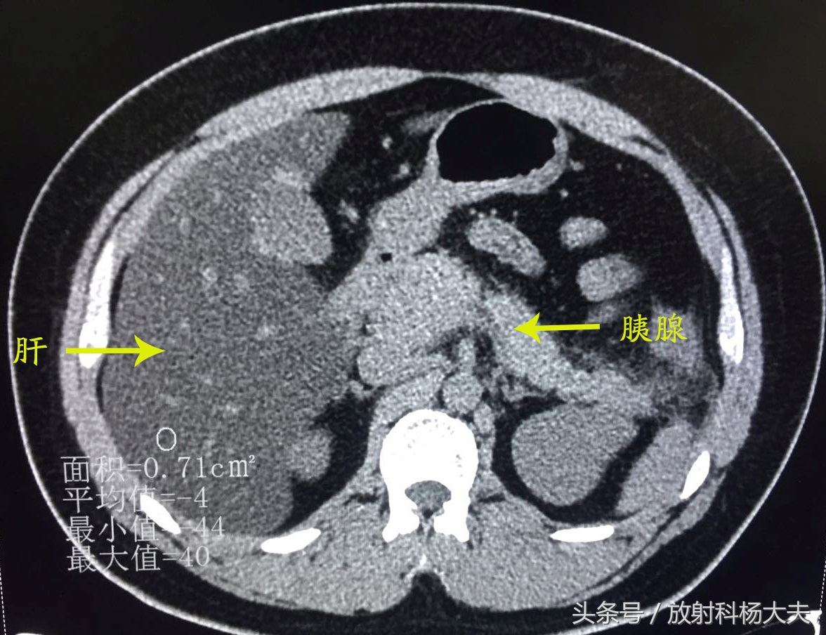 胰腺占位饭后肚子痛,吃火锅后肚子隐隐作痛