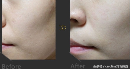 果酸用途及功效,果酸是治疗皮肤的什么