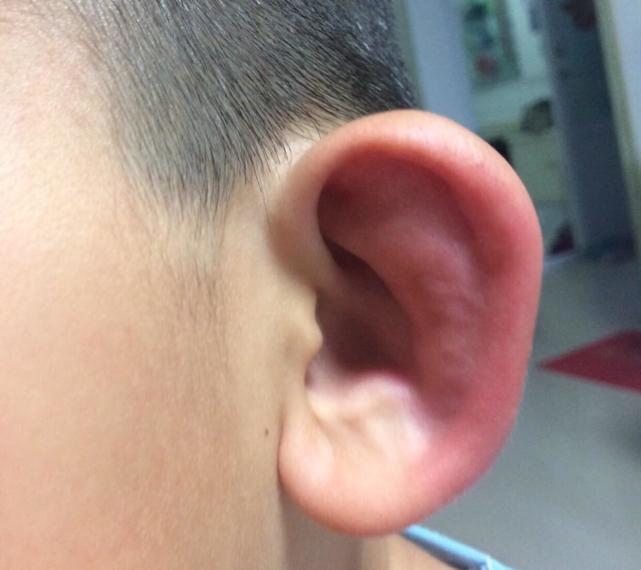 孩子小手被蚊子咬了后肿了,宝宝手被蚊子咬了个大包怎么办