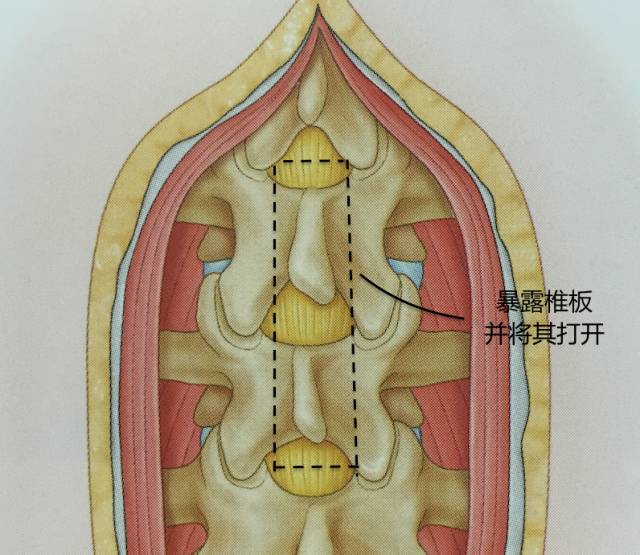 腰腿疼是椎管肿瘤吗,腰腿疼痛需要关注脊髓肿瘤吗