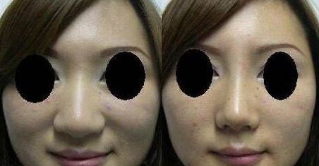 鼻翼缩小鼻子更大,让鼻翼缩小的方法