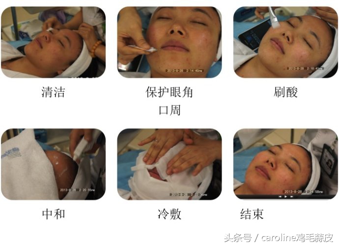 果酸用途及功效,果酸是治疗皮肤的什么