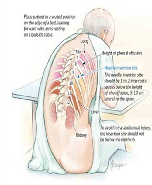 结核性胸膜炎胸痛中医治疗,胸痛12种图解