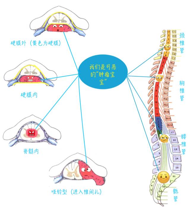 腰腿疼是椎管肿瘤吗,腰腿疼痛需要关注脊髓肿瘤吗