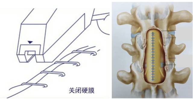 腰腿疼是椎管肿瘤吗,腰腿疼痛需要关注脊髓肿瘤吗