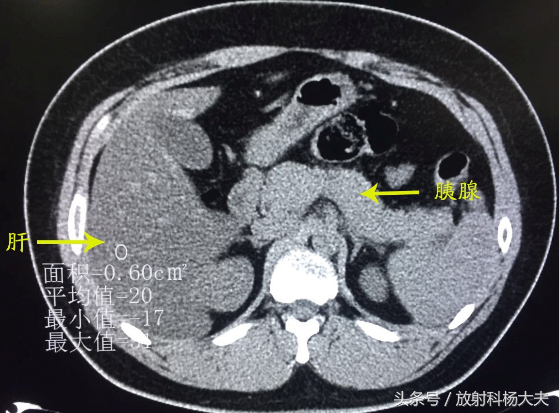 胰腺占位饭后肚子痛,吃火锅后肚子隐隐作痛