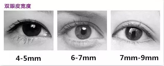 和阿姨的双眼皮做的太宽失败了