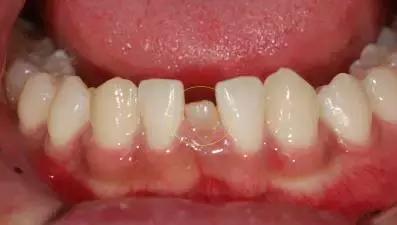 孩子牙齿畸形怎么办,小孩子牙畸形怎么办