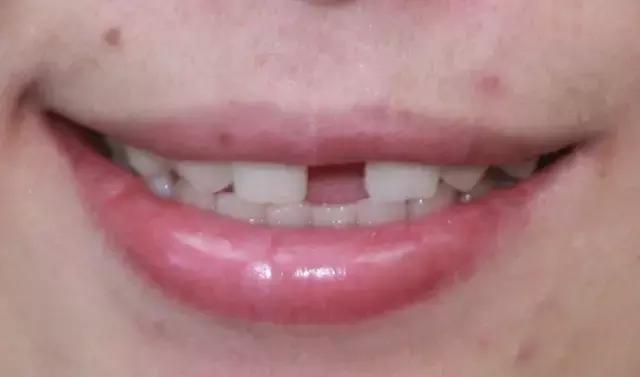 孩子牙齿畸形怎么办,小孩子牙畸形怎么办